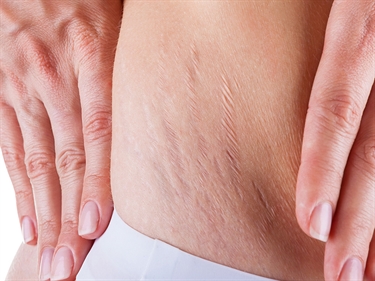 Do Stretch Marks Itch When Losing Weight