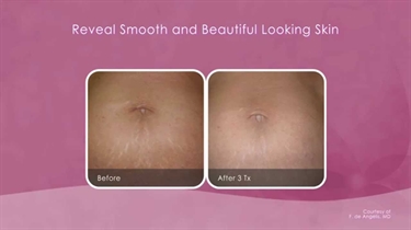 What To Use To Avoid Stretch Marks In Pregnancy