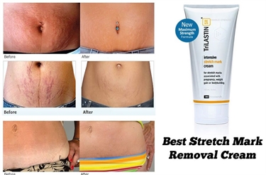 Best Cream Prevent Stretch Marks Pregnancy