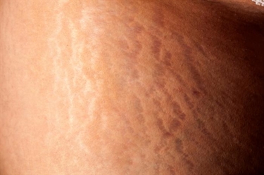 How To Make Stretch Marks Less Visible