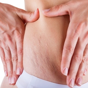 What Helps Remove Stretch Marks