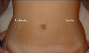 How To Get Rid Of Old Scars And Stretch Marks