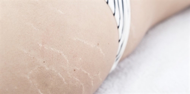 How To Remove Stretch Marks Quickly