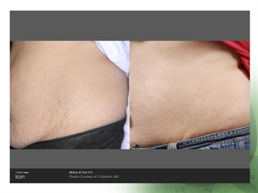 What Helps Prevent Stretch Marks