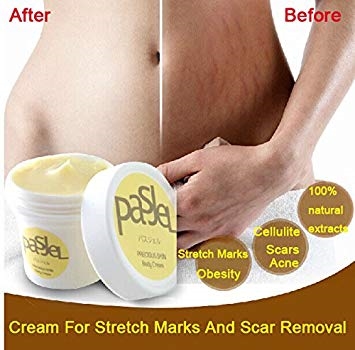 Does Cocoa Butter Reduce Stretch Marks