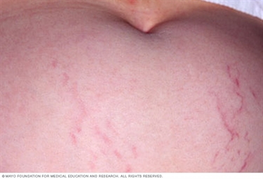 Is It Possible To Prevent Stretch Marks During Pregnancy