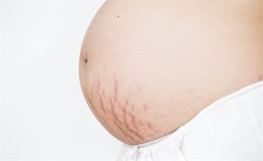 How To Minimalize Stretch Marks During Pregnancy
