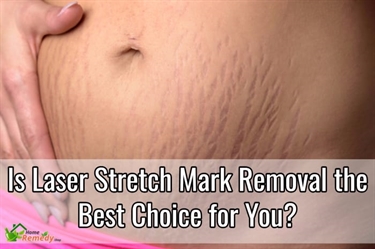 How To Get Rid Of Stretch Marks Naturally