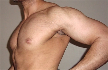 Will Stretch Marks On Breast Go Away After Pregnancy