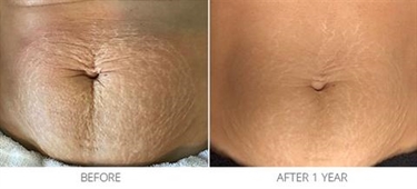 How To Help Prevent Stretch Marks During Pregnancy