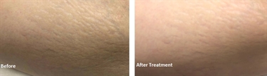 How To Get Rid Of Stretch Marks In 2 Days