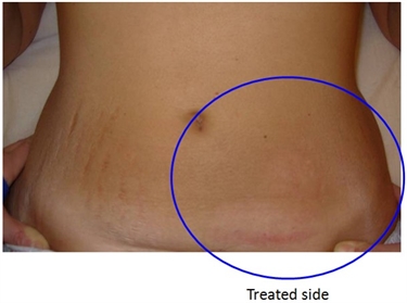 Stretch Marks Treatment After Pregnancy