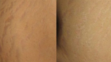 How To Prevent Stretch Marks On Arms