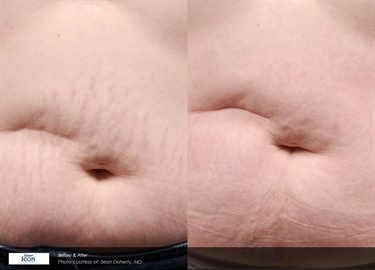 Best Way To Avoid Pregnancy Stretch Marks