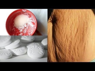 How To Prevent Pregnancy Stretch Marks