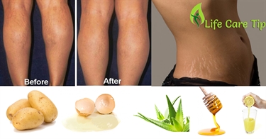 What To Prevent Stretch Marks During Pregnancy