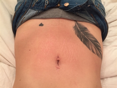All Natural Stretch Mark Prevention