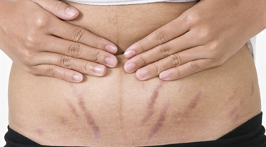 How To Remove Stretch Marks On Legs