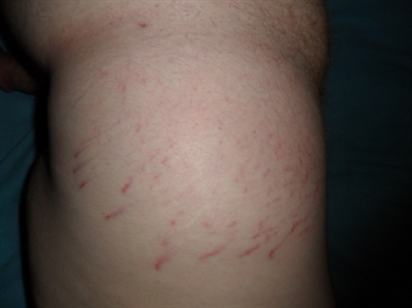 How To Improve Stretch Marks