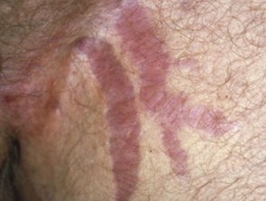 Natural Remedies To Get Rid Of Stretch Marks