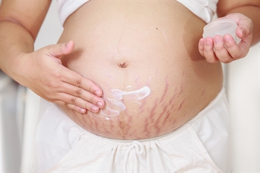 How To Prevent Stretch Marks With Pregnancy