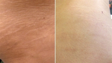 What To Use To Fade Scars