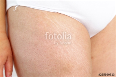 Prevent Stretch Marks Cream
