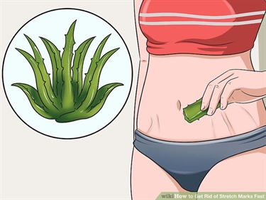 Stretch Mark Solutions