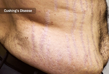 Remove Stretch Marks On Buttocks