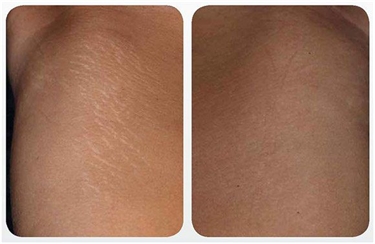 Stretch Mark Workout
