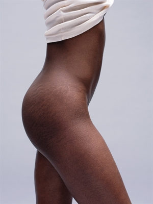 Prevent Stretch Marks Naturally