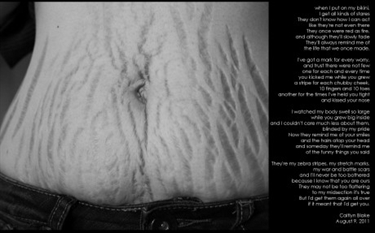 What Helps Reduce Stretch Marks During Pregnancy