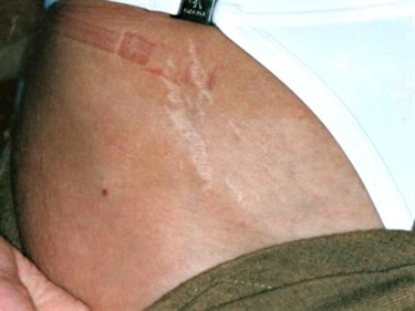 How To Cover Up Stretch Marks On Arms