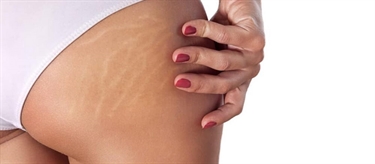 Rid Stretch Marks After Pregnancy