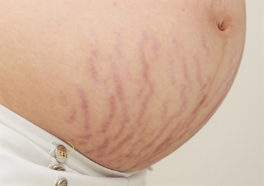 How To Remove Stretch Marks From Body
