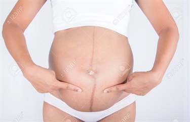 Pregnancy Creams Stretch Marks