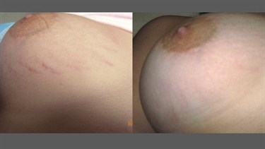 Pregnancy Scars