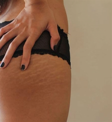 Best Thing To Use To Prevent Pregnancy Stretch Marks