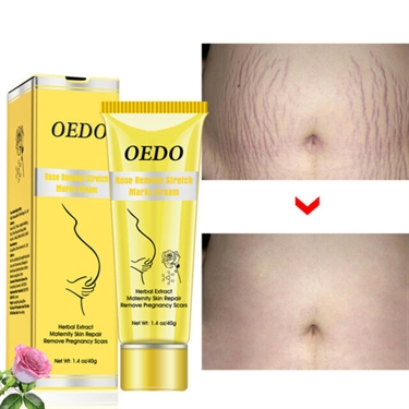 Developing Stretch Marks