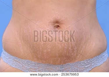 How To Prevent Stretch Marks During Pregnancy Cocoa Butter