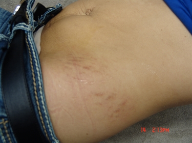 Creams For Stretch Marks That Work