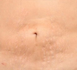 What Can I Put On Stretch Marks