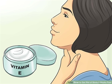 Permanently Remove Stretch Marks