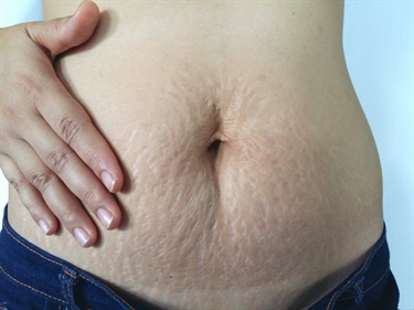 How We Get Stretch Marks During Pregnancy