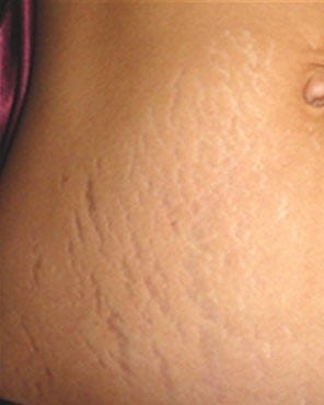 What To Apply To Prevent Stretch Marks During Pregnancy