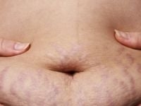 Retinol Stretch Mark