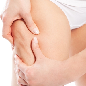 How To Reduce The Apperance Of Stretch Marks