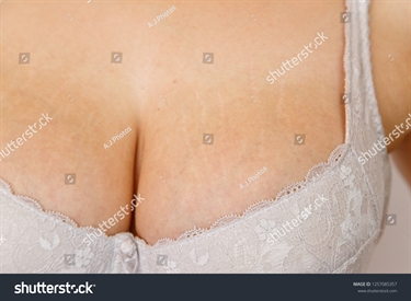 How To Get Rid Of Marks On Body