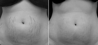 Itchy Between Breasts