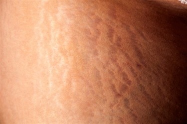 What To Use On Itchy Stretch Marks During Pregnancy